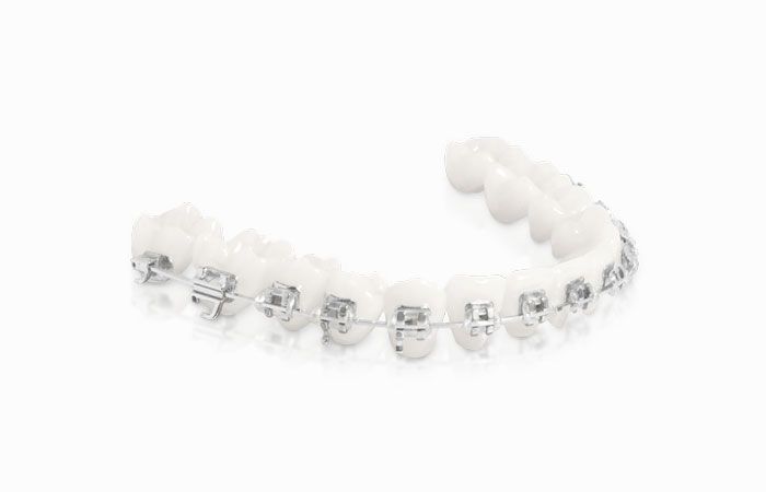 Aparat ortodontyczny stały z zamkami  Victory 3M™