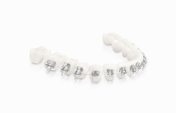 Aparat ortodontyczny stały z zamkami SmartClip™