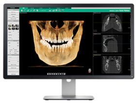 Cyfrowa diagnostyka 3D i projektowanie w implantologii
